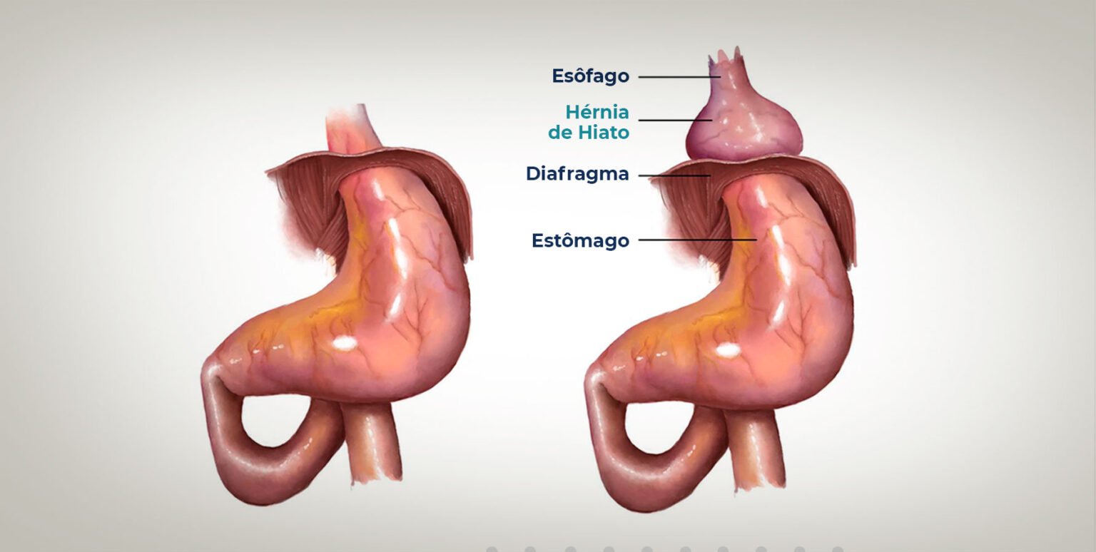 Hérnia Epigástrica: O que é, Sintomas, Causas e Tratamentos - Dr Renato ...